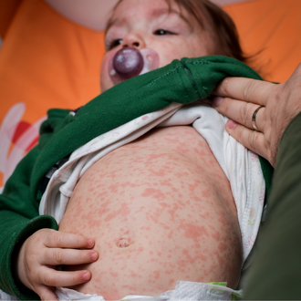 Measles Outbreak